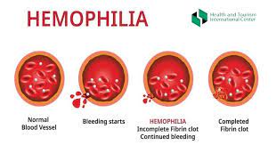 Experts advocate increased awareness, treatment for hemophilia disease